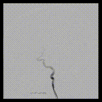 Cerebral angiogram