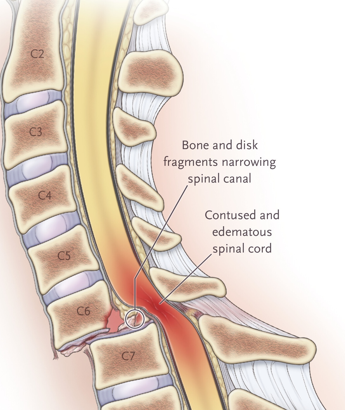 Spinal cord compression