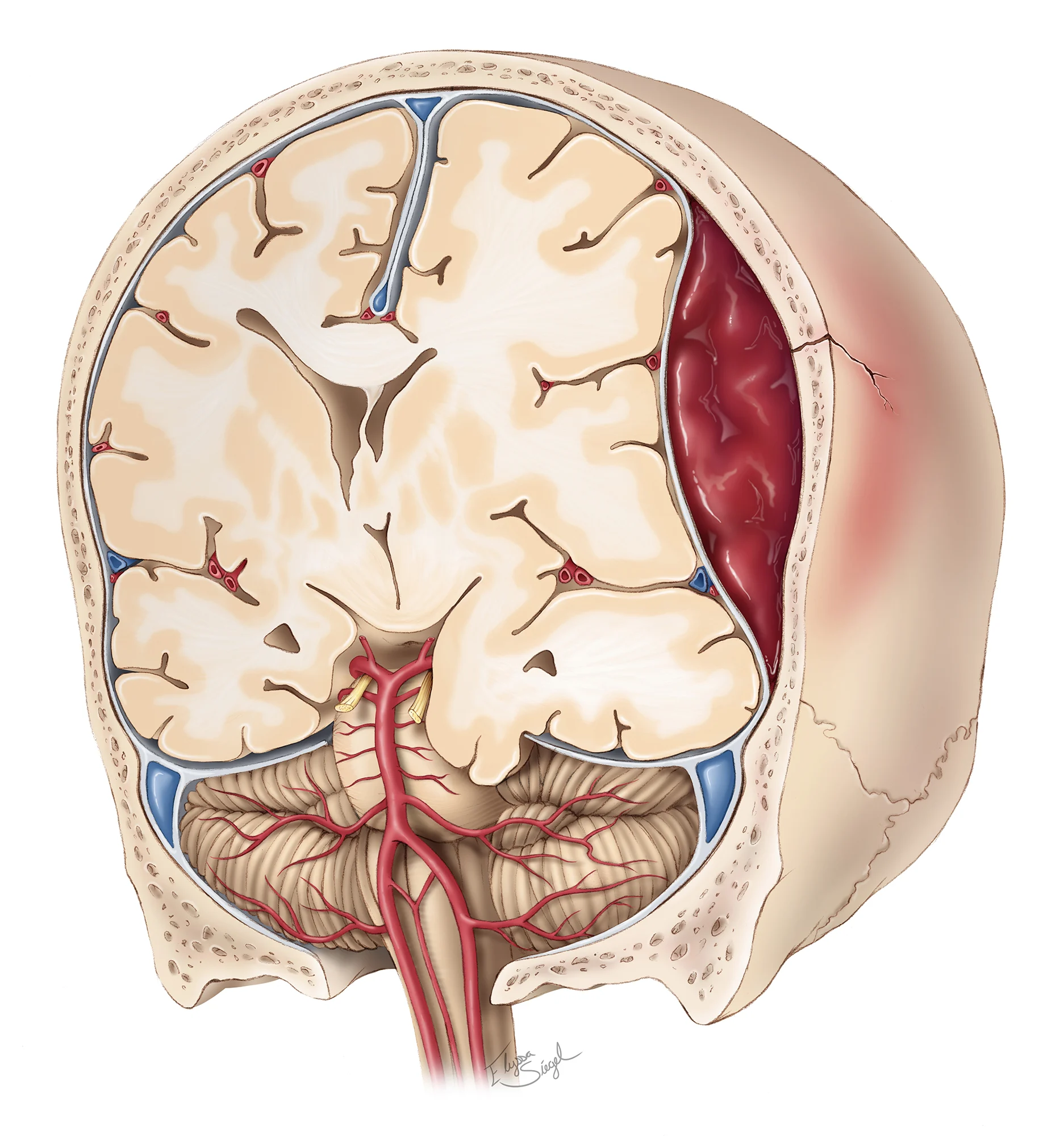 Epidural hematoma