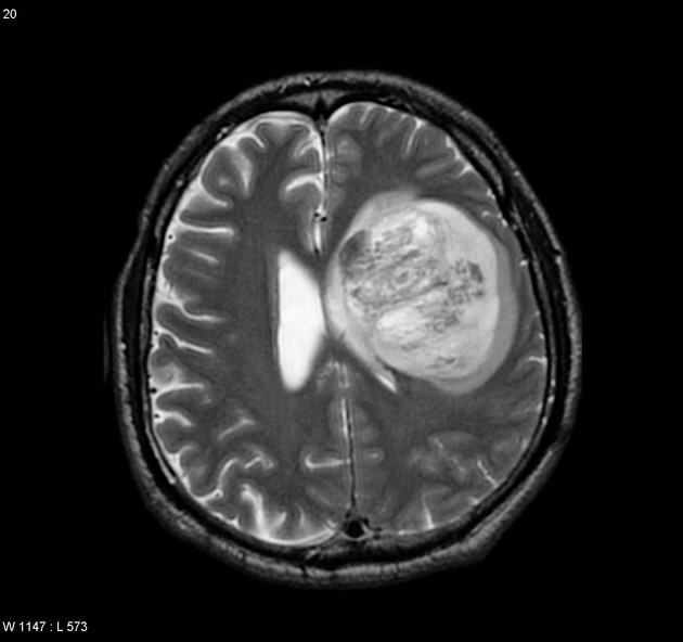 Glioblastoma MRI