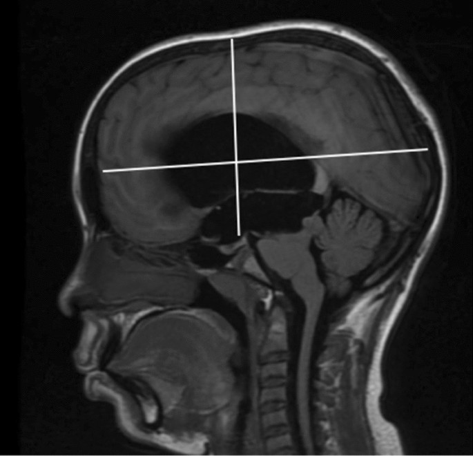 Pediatric hydrocephalus MRI